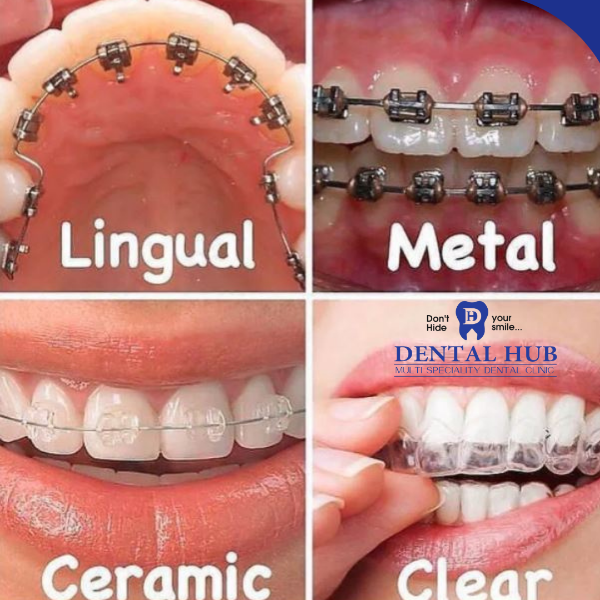 ORTHODONTIC TREATMENT - STEEL AND CERAMIC BRACES , CLEAR ALIGNER