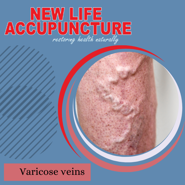 VARICOSE VEINS