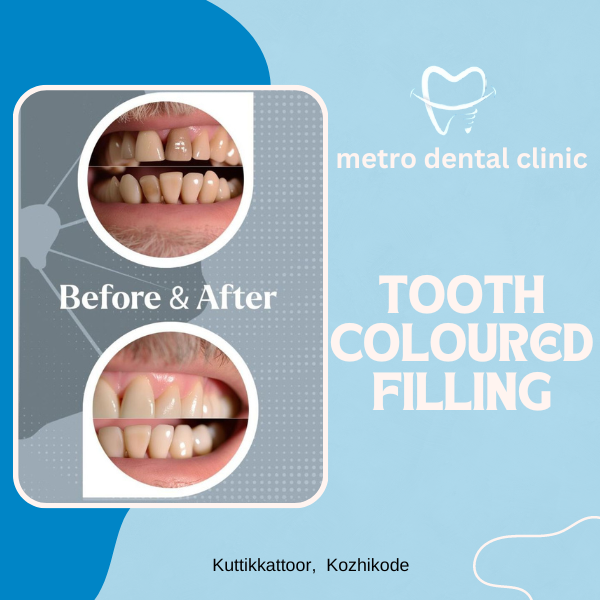 tooth coloured filling