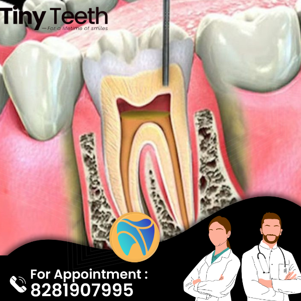 Root canal Treatment