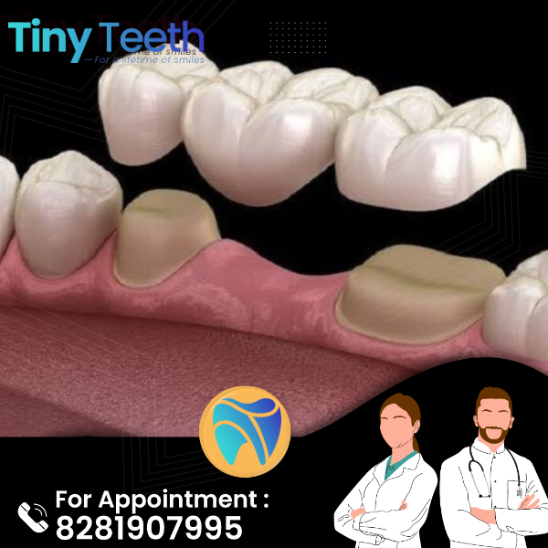 Bridges and Partial Dentures