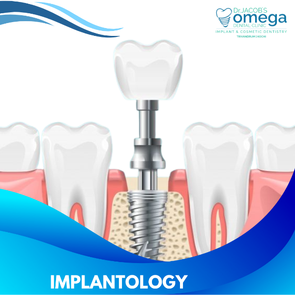 IMPLANTOLOGY