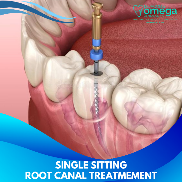 SINGLE ROOT CANAL TREATMENT