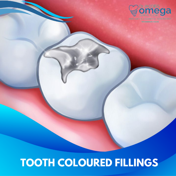 TOOTH COLOURED FILLINGS