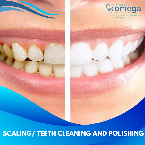 SCALING/TEETH CLEANING AND POLISHING