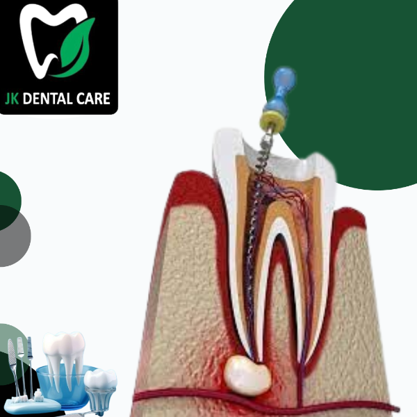 Root canal Treatment