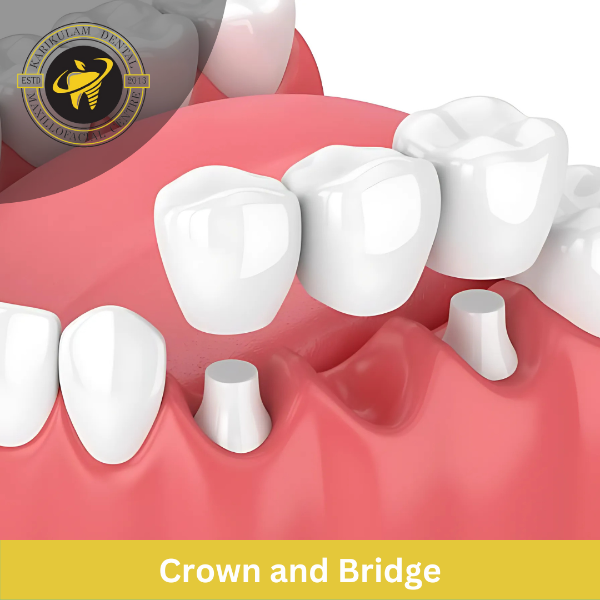 Crowns and bridges