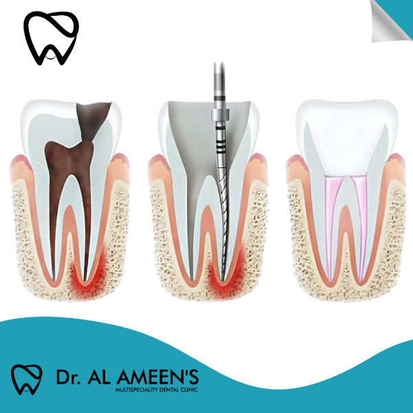 Root canal Treatment