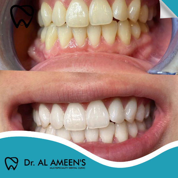 Teeth Whitening