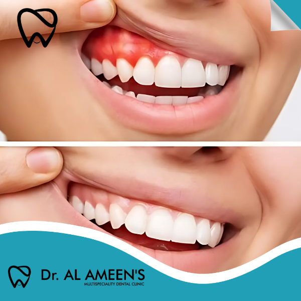 GUM SURGERY