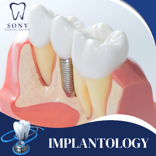 IMPLANTOLOGY