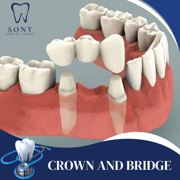 CROWN AND BRIDGE