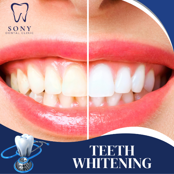 TEETH WHITENING