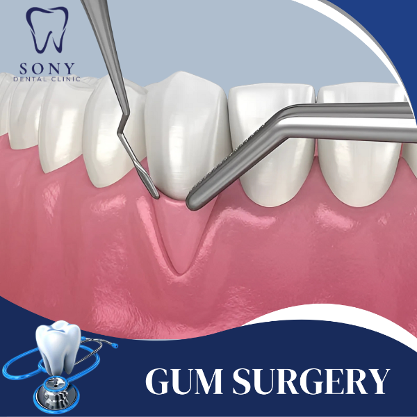 GUM SURGERY