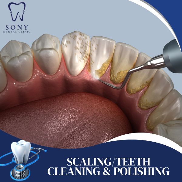 SCALING/TEETH CLEANING & POLISHING