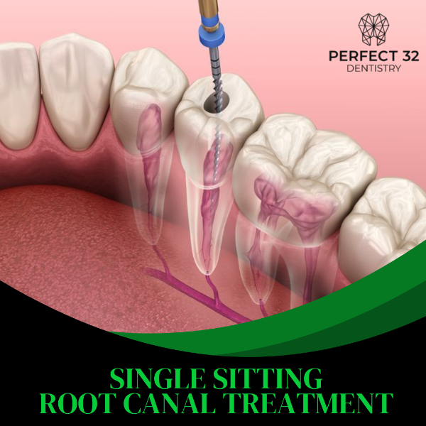 SINGLE SITTING ROOT CANAL TREATMENT