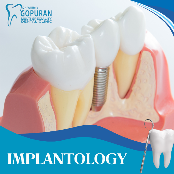 IMPLANTOLOGY