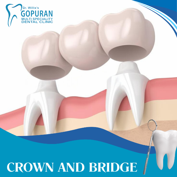 CROWN AND BRIDGE