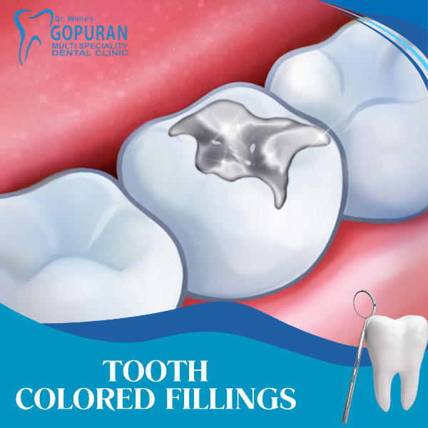 TOOTH COLOURED FILLINGS
