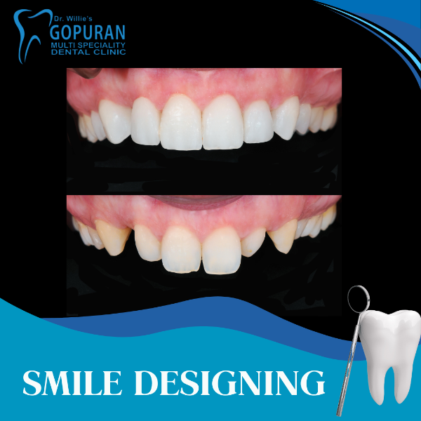 SMILE DESIGNING