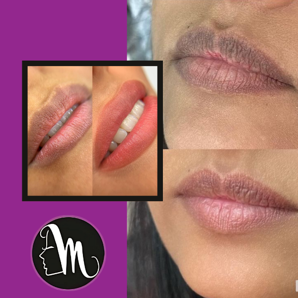 Lip pigmentation Treatment