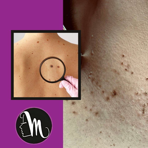 Warts and Mole removal