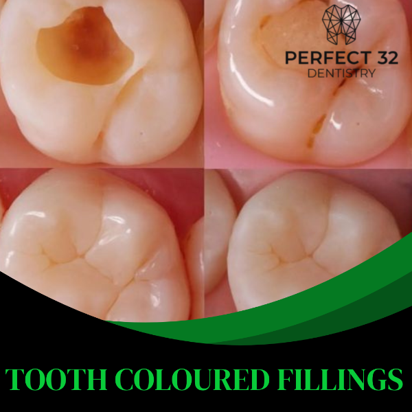 TOOTH COLOURED FILLINGS