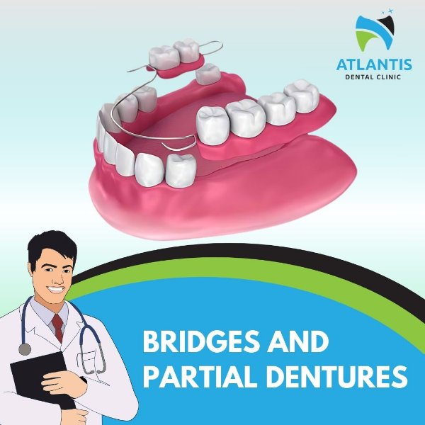 Bridges and partial dentures