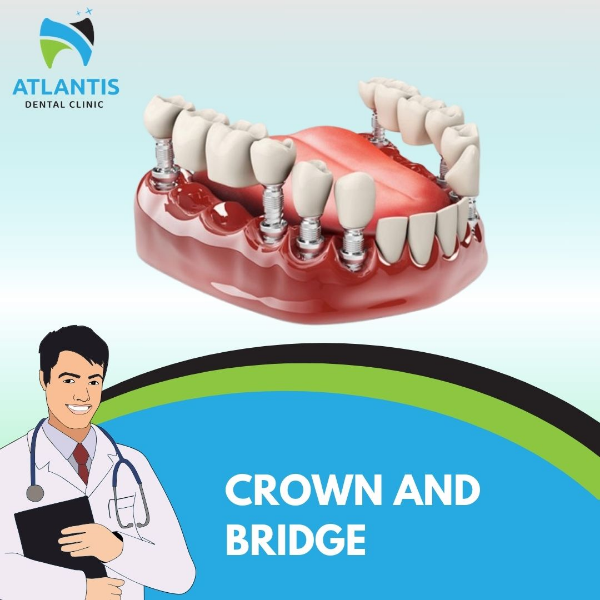 Crown and Bridge