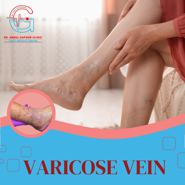 VARICOSE VEIN
