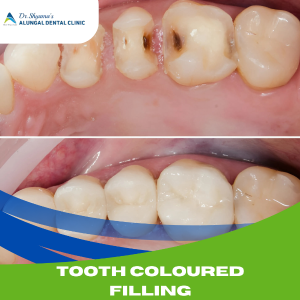 TOOTH COLOURED FILLINGS