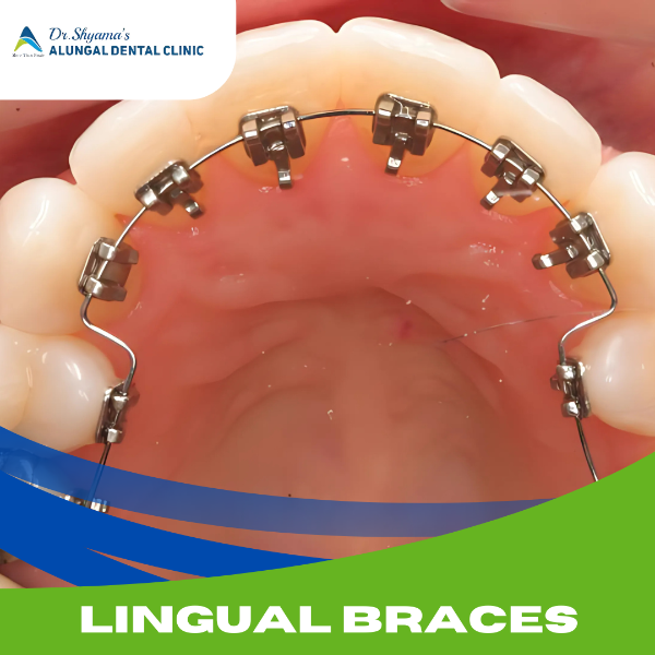 LINGUAL BRACES