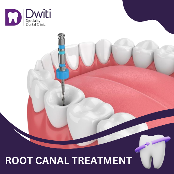 ROOT CANAL TREATMENT