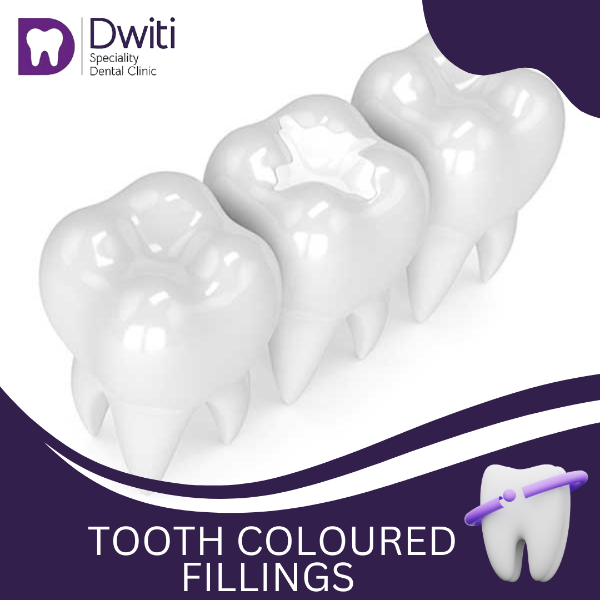 TOOTH COLOURED FILLINGS