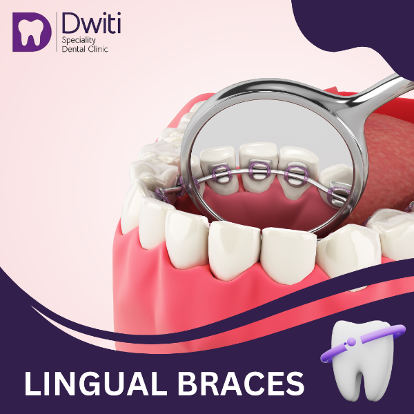 LINGUAL BRACES