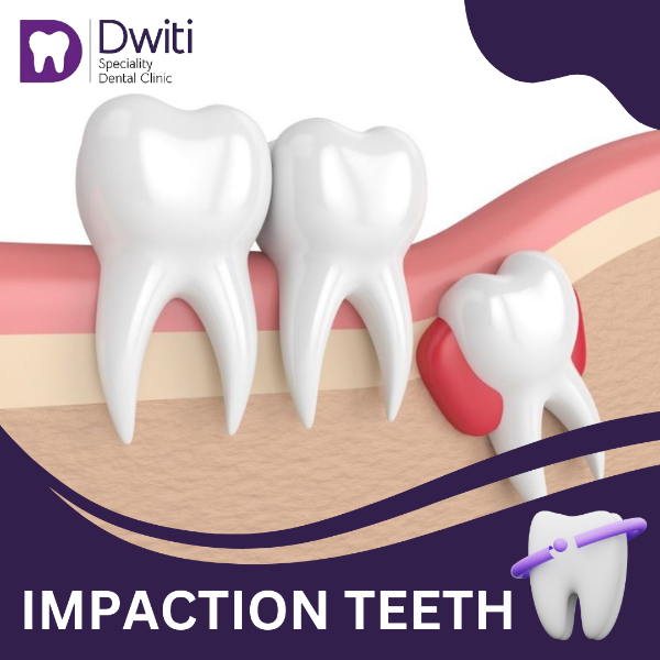 IMPACTION TEETH