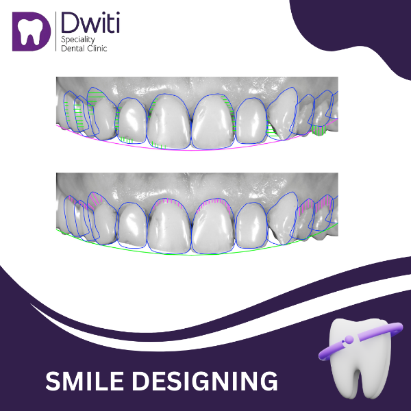 SMILE DESIGNING