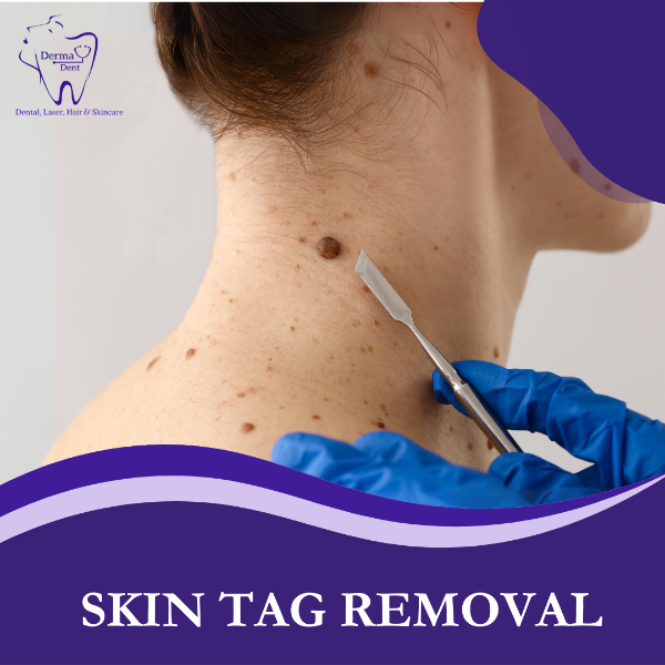 SKIN TAG REMOVAL