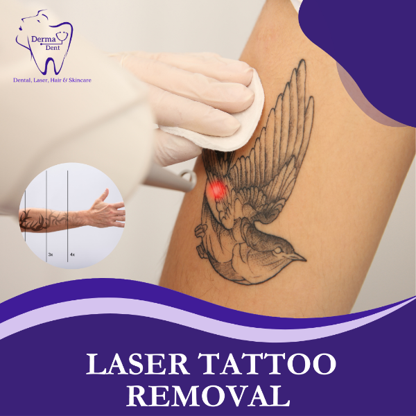 LASER TATTOO