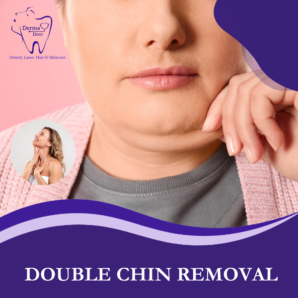 DOUBLE CHIN REMOVAL