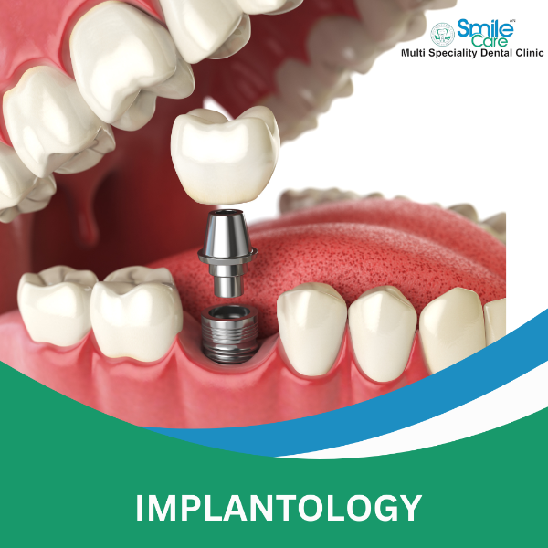 IMPLANTOLOGY