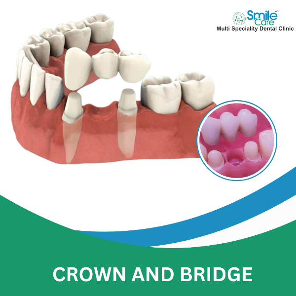 CROWN AND BRIDGE
