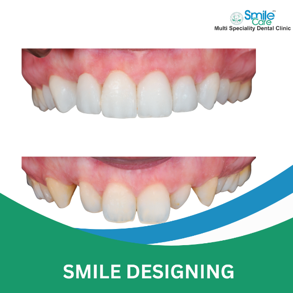 SMILE DESIGNING