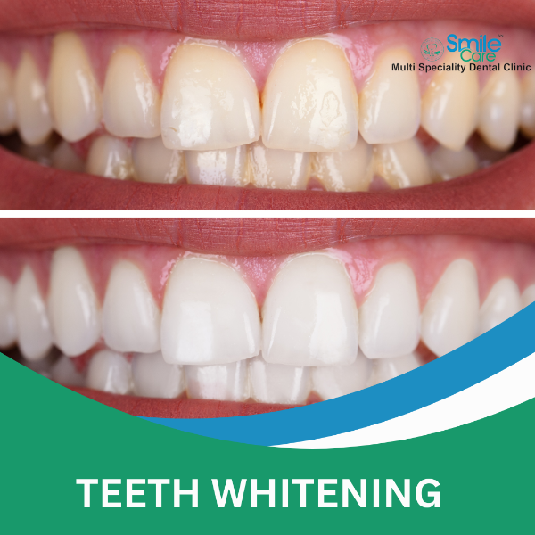TEETH WHITENING