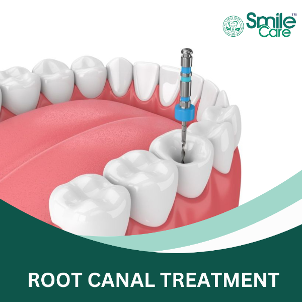 ROOT CANAL TREATMENT
