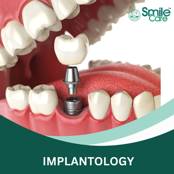 IMPLANTOLOGY