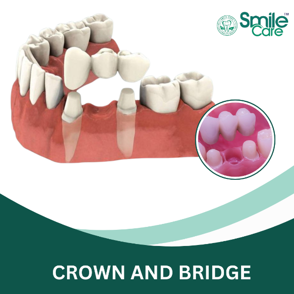 CROWN AND BRIDGE