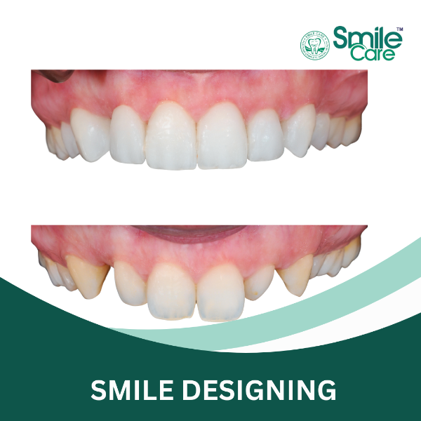 SMILE DESIGNING