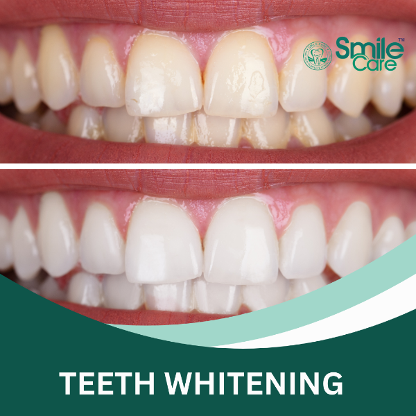TEETH WHITENING