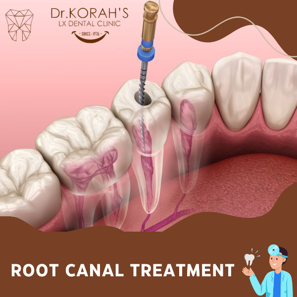 ROOT CANAL TREATMENT